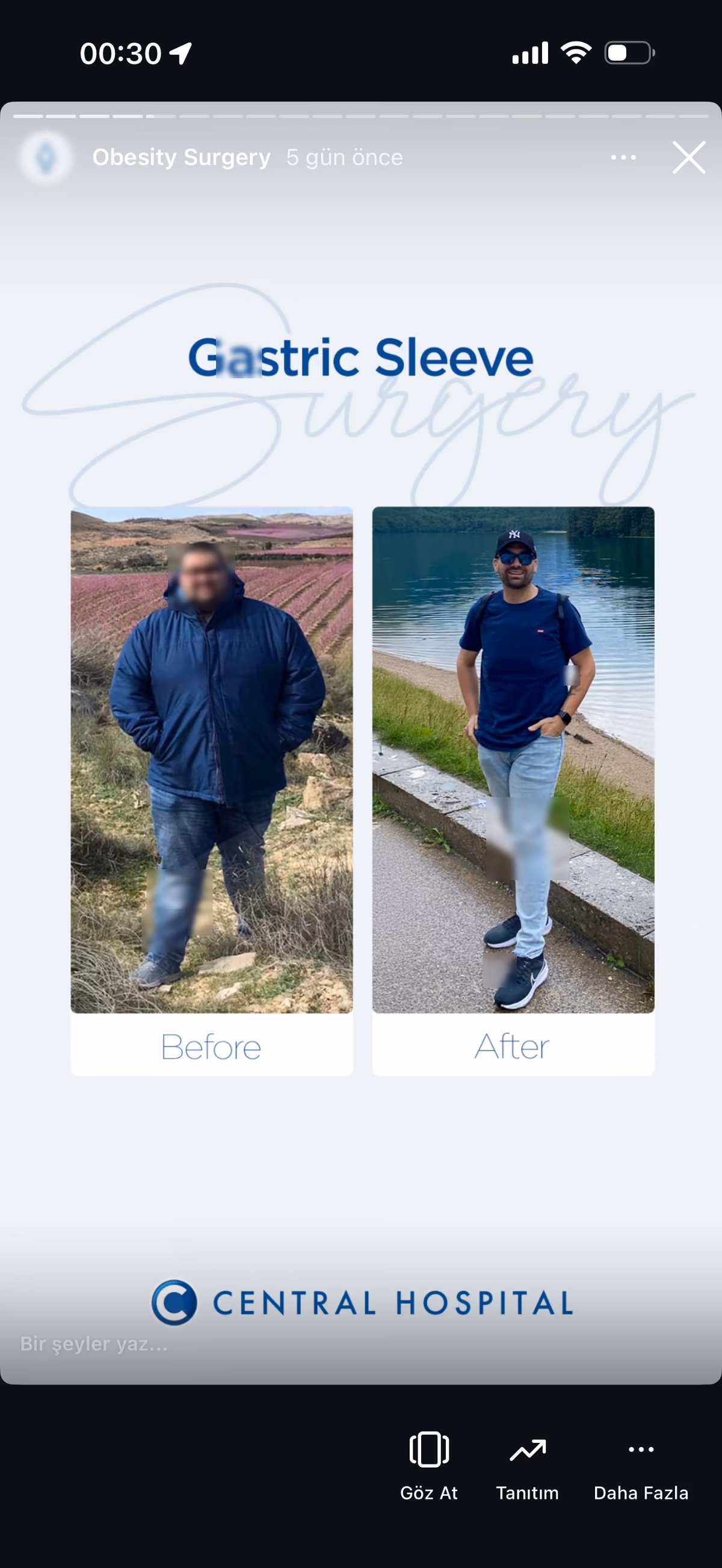 Risultato bypass gastrico — paziente SlimFit Turkey 1
