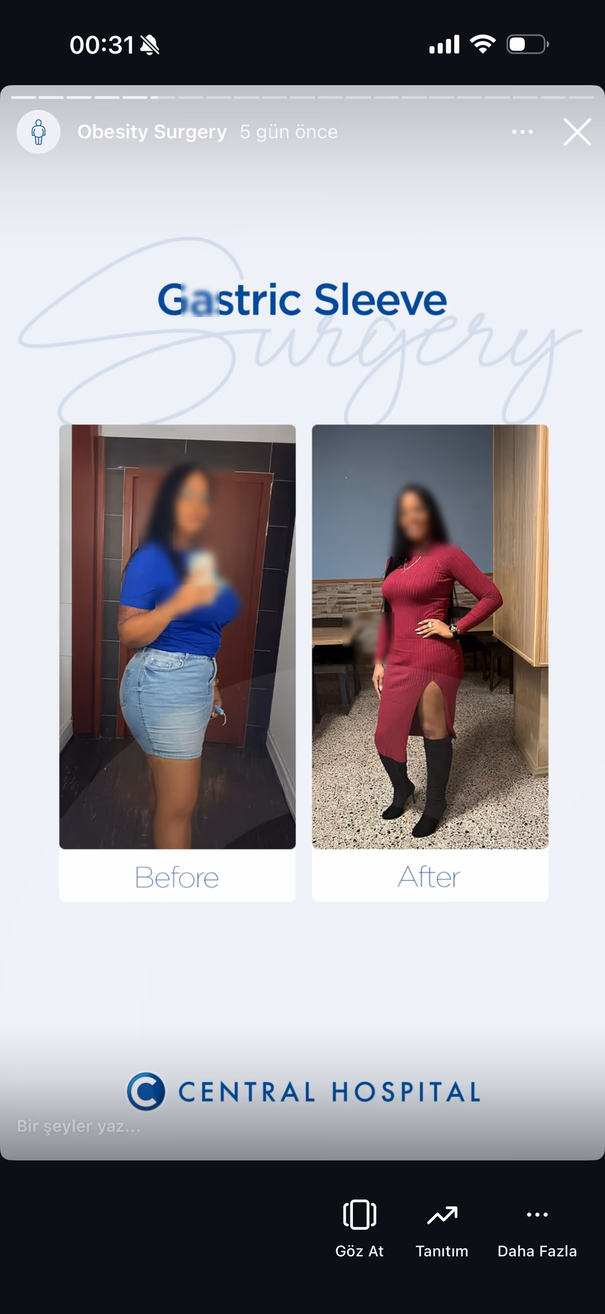 Risultato sleeve gastrectomy — paziente SlimFit Turkey 2