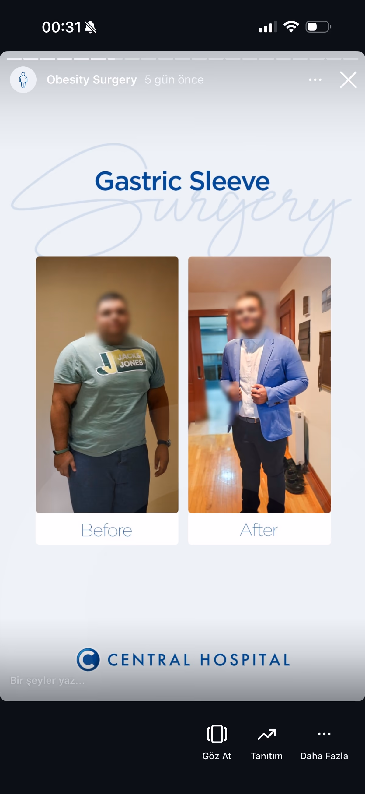 Risultato sleeve gastrectomy — paziente SlimFit Turkey 3