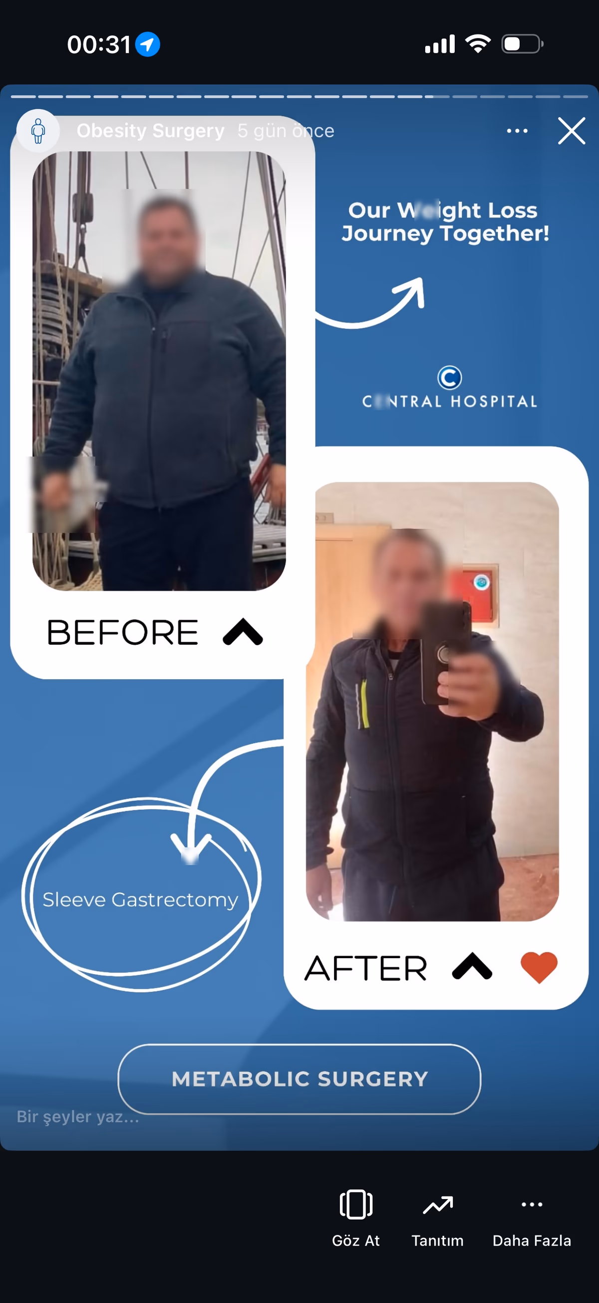 Risultato sleeve gastrectomy — paziente SlimFit Turkey 5