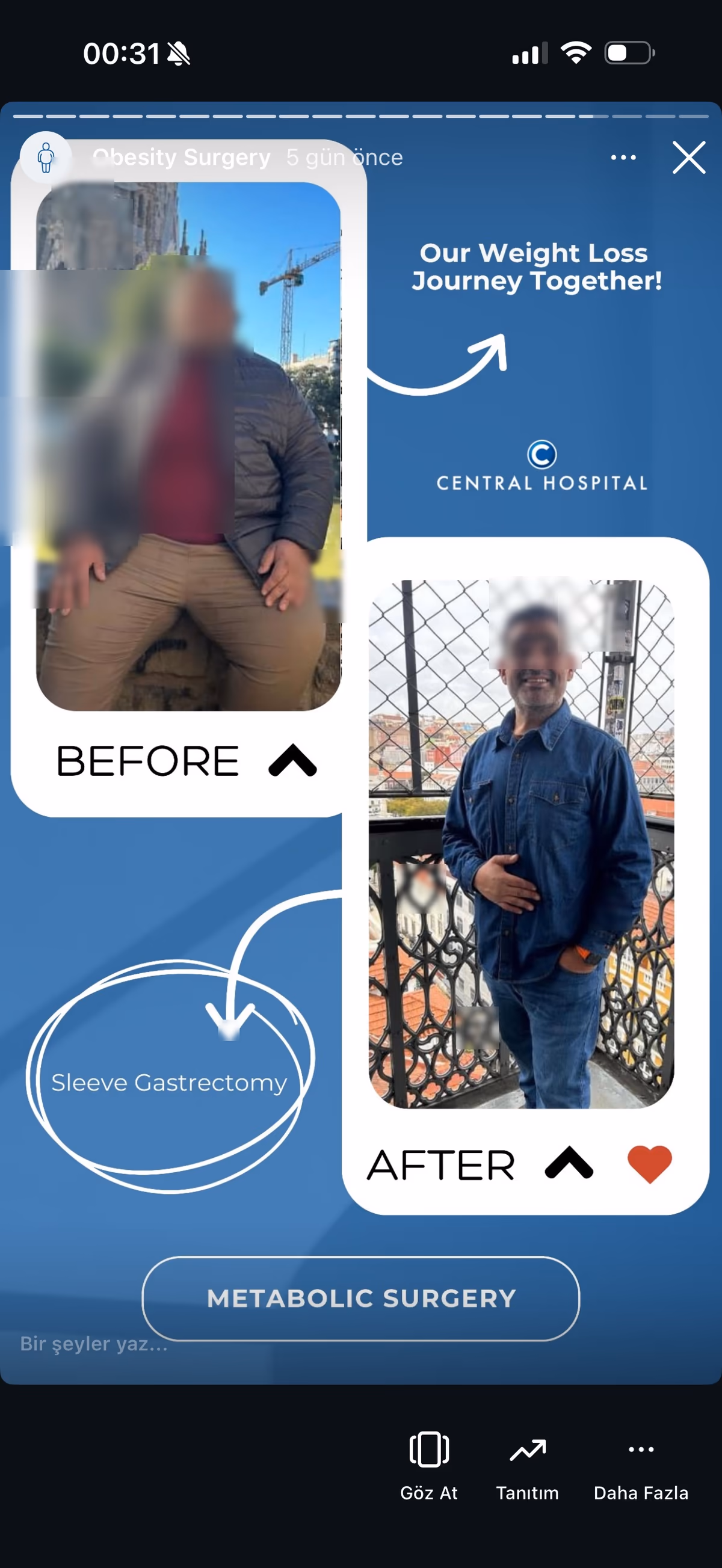Risultato sleeve gastrectomy — paziente SlimFit Turkey 6