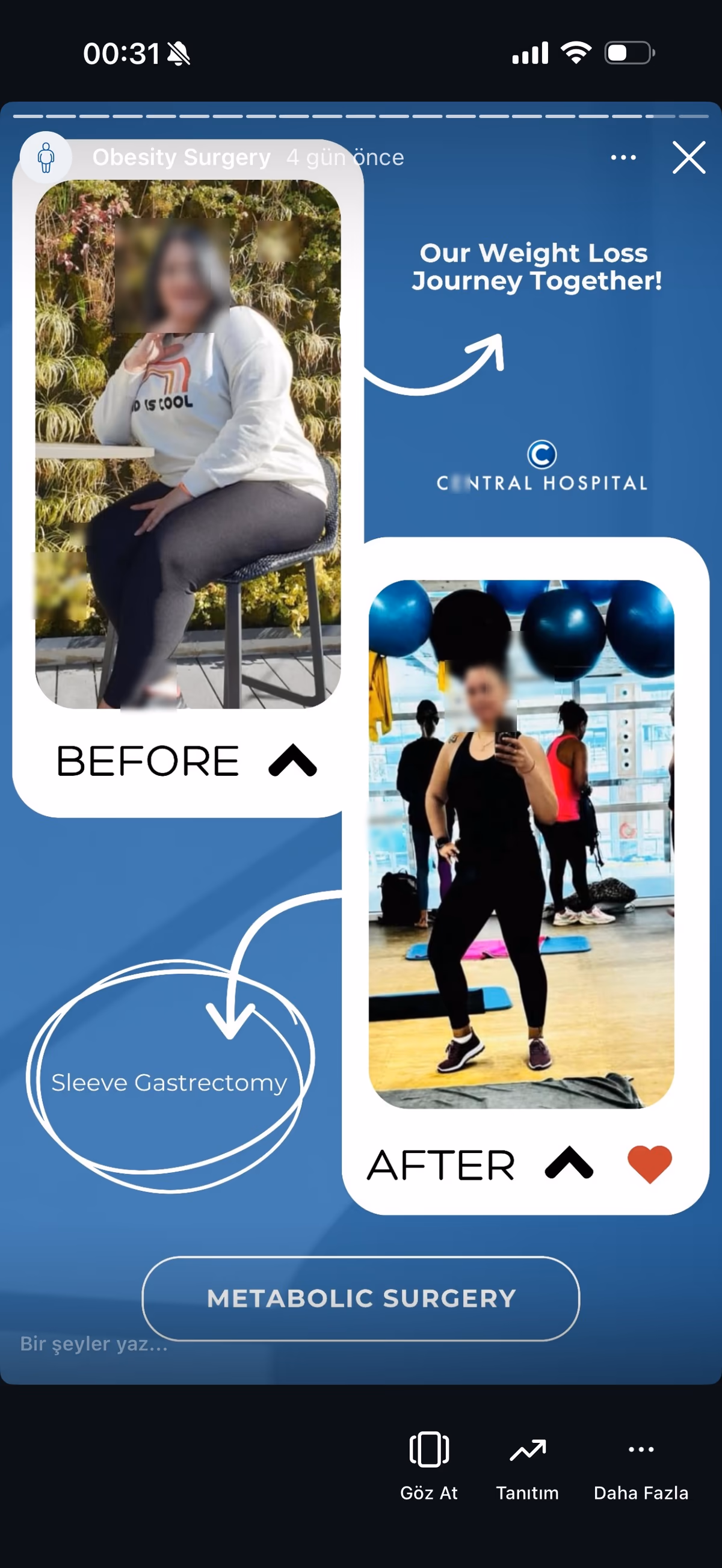 Risultato bypass gastrico — paziente SlimFit Turkey 7