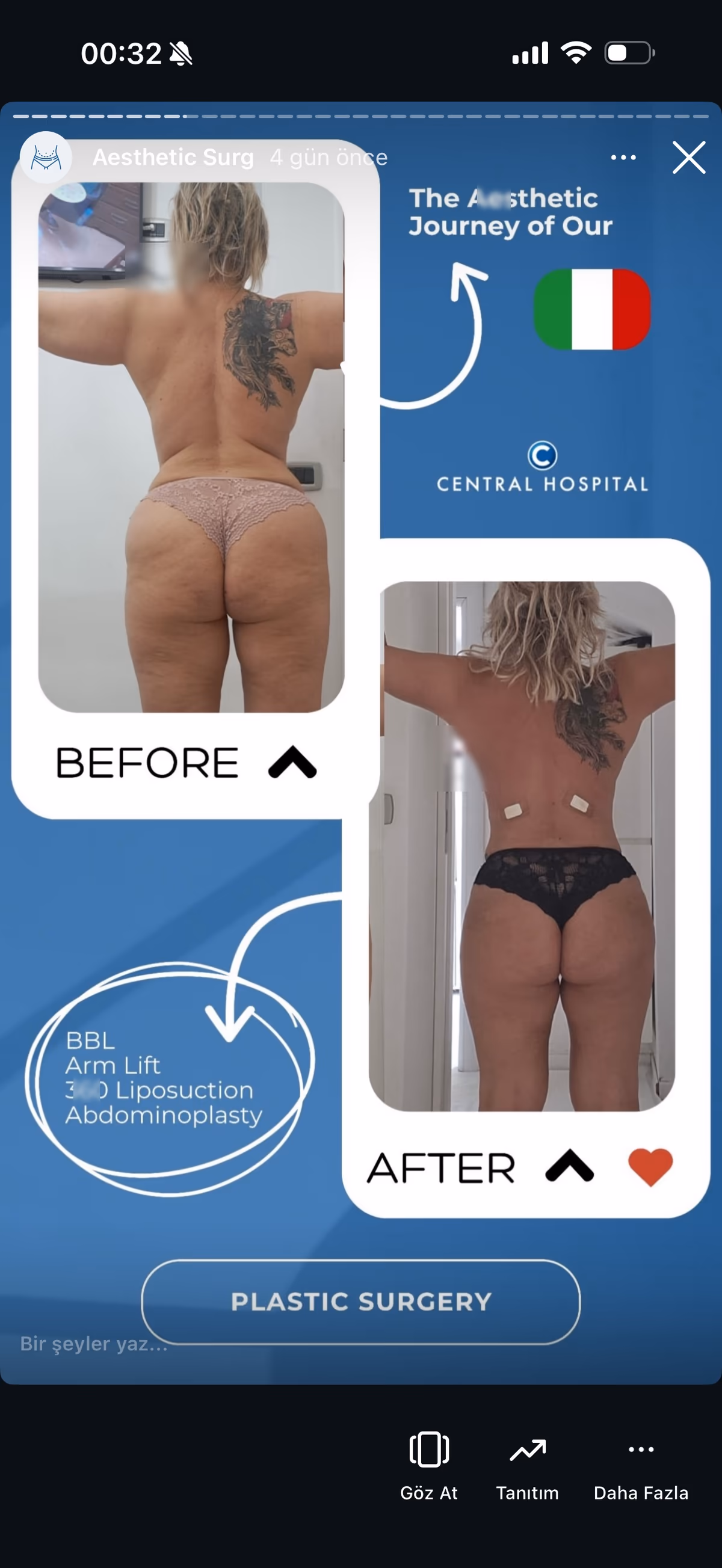 Risultato ginecomastia — paziente SlimFit Turkey 1