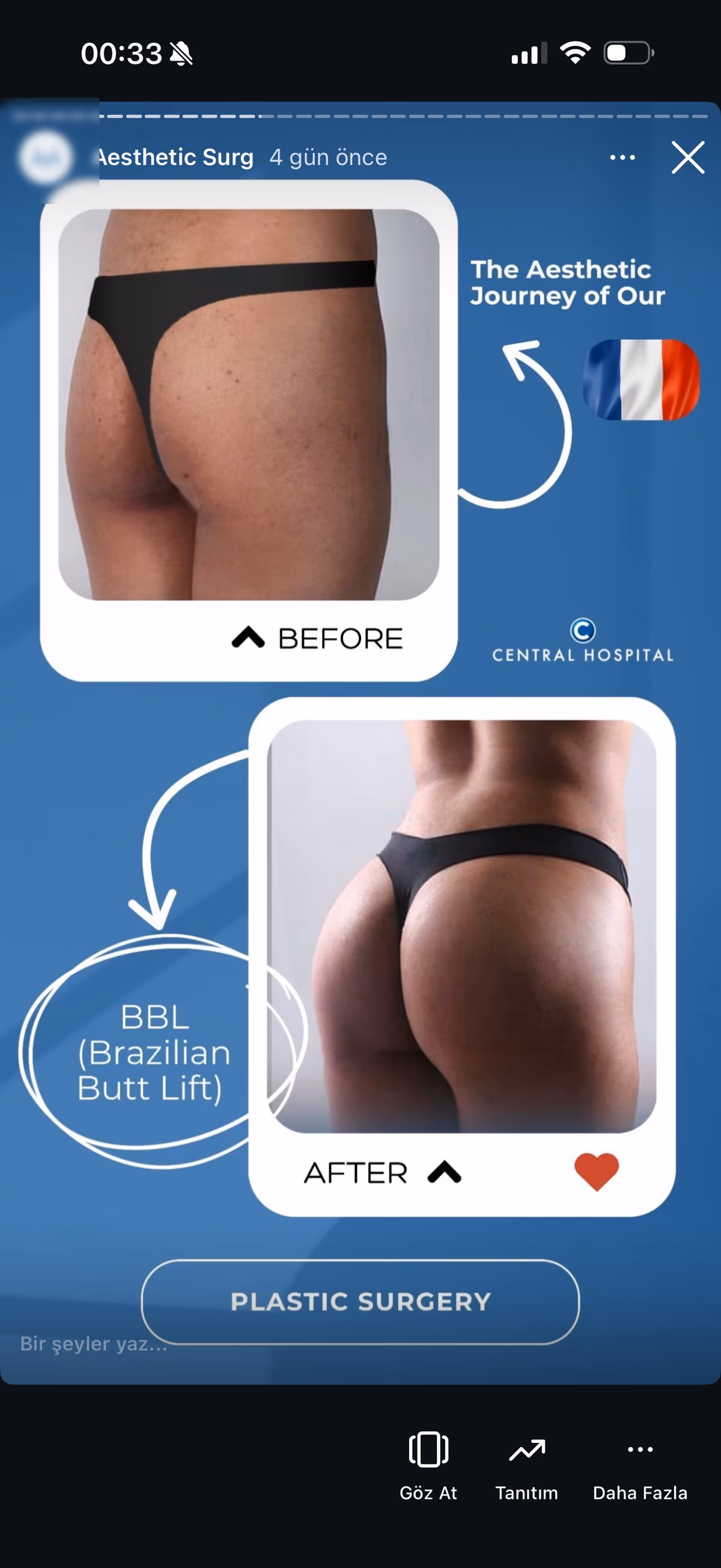 Risultato ginecomastia — paziente SlimFit Turkey 2