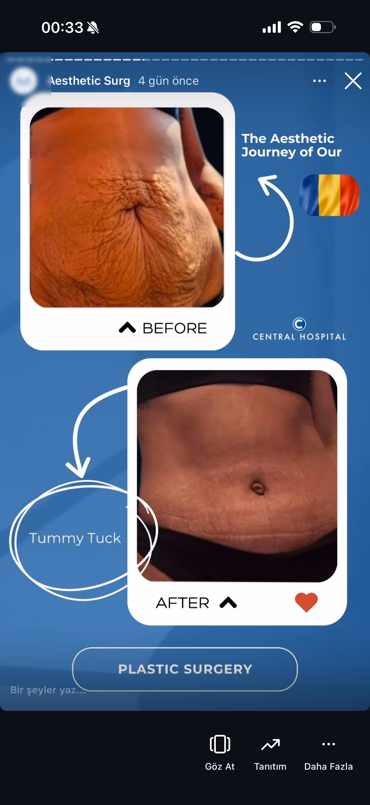 Risultato ginecomastia — paziente SlimFit Turkey 3
