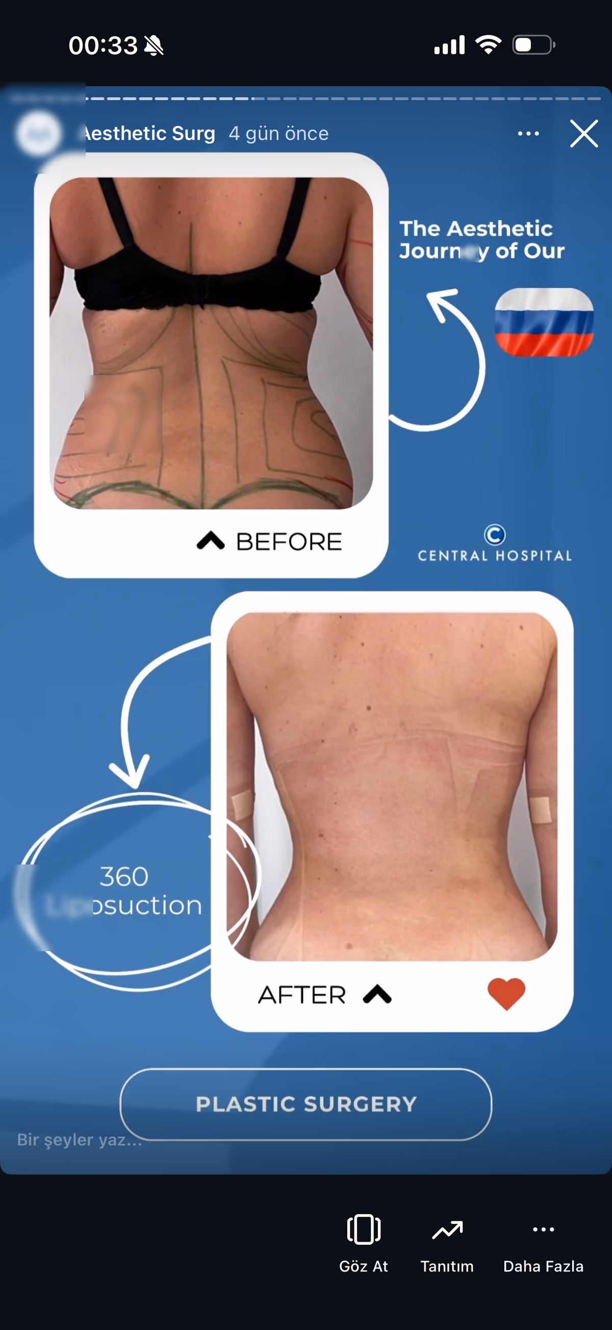 Risultato ginecomastia — paziente SlimFit Turkey 4