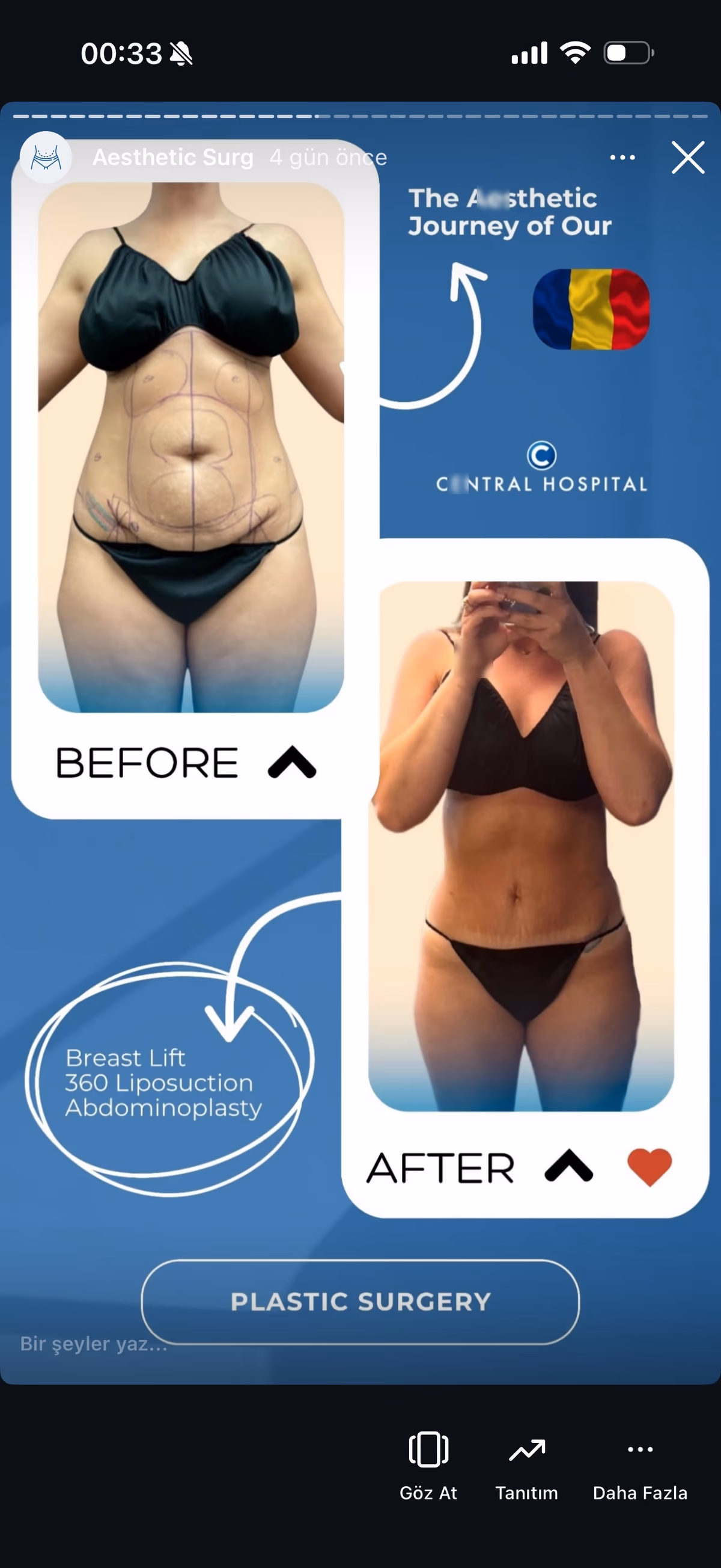 Risultato ginecomastia — paziente SlimFit Turkey 5