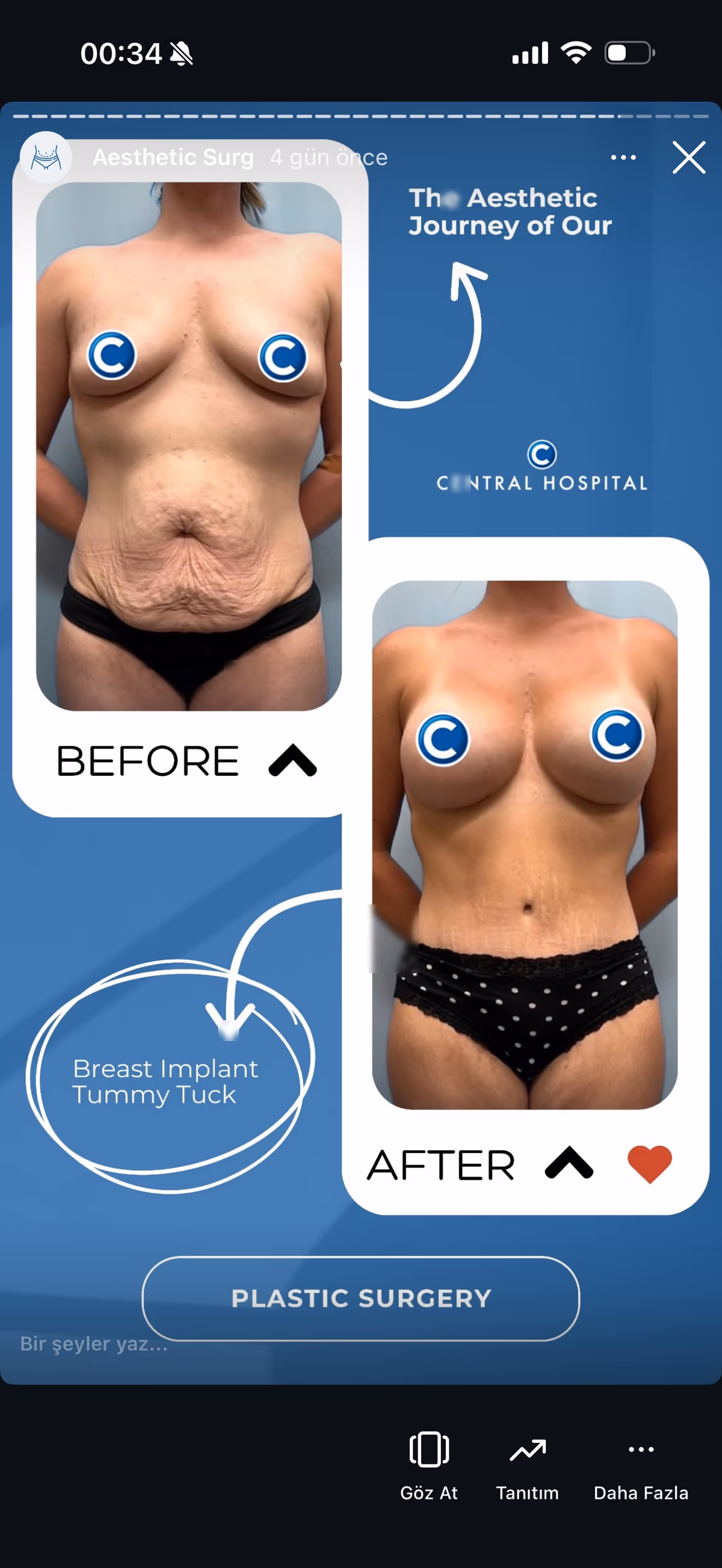 Risultato ginecomastia — paziente SlimFit Turkey 8
