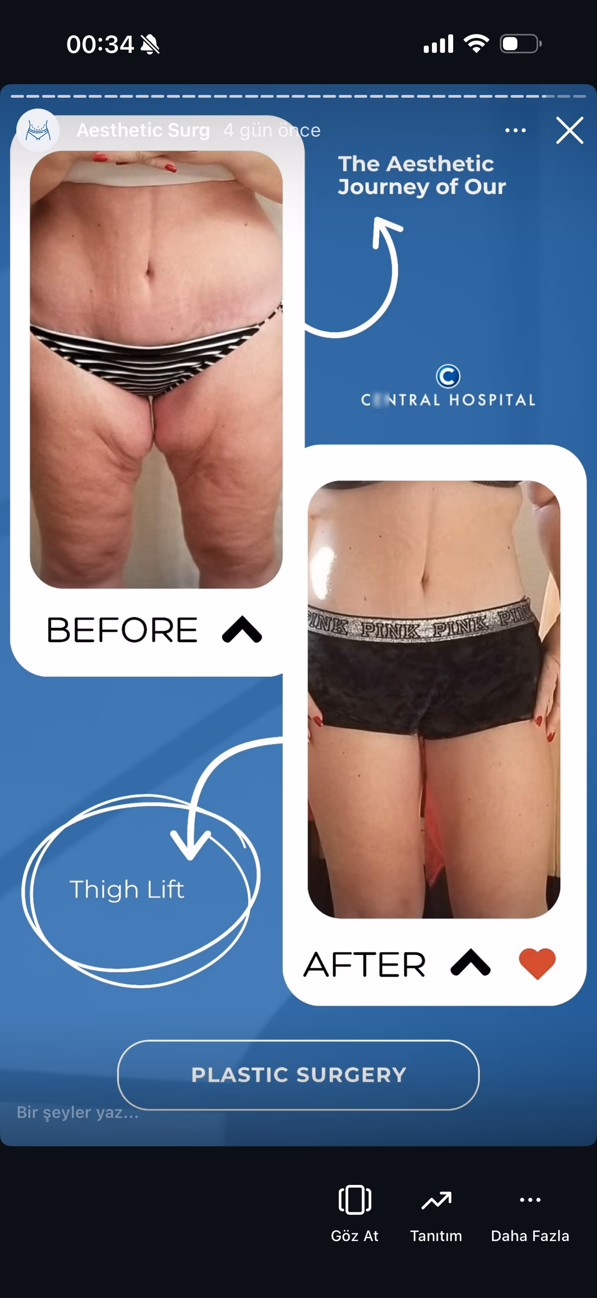 Risultato ginecomastia — paziente SlimFit Turkey 9