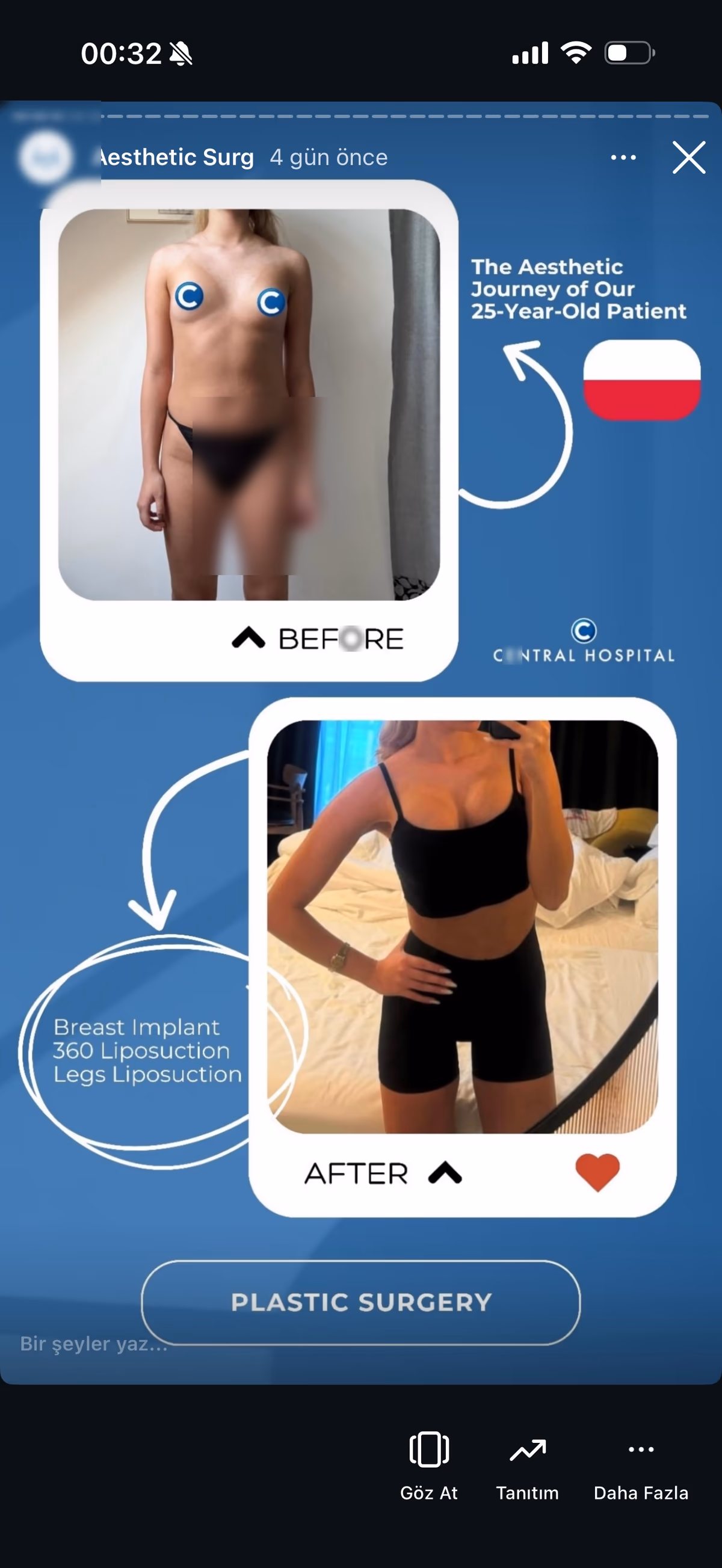 Risultato mastoplastica additiva — paziente SlimFit Turkey 2