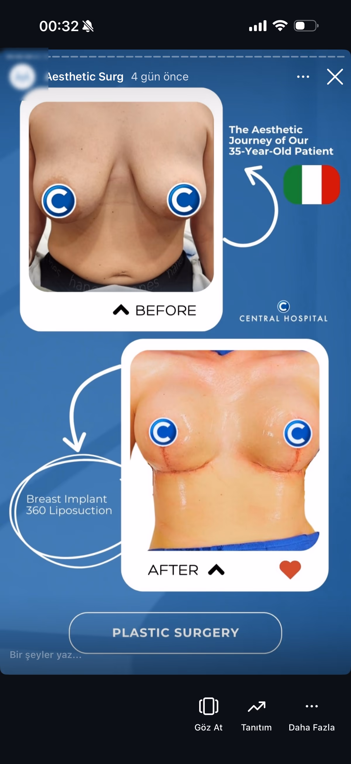 Risultato mastopessi — paziente SlimFit Turkey 3