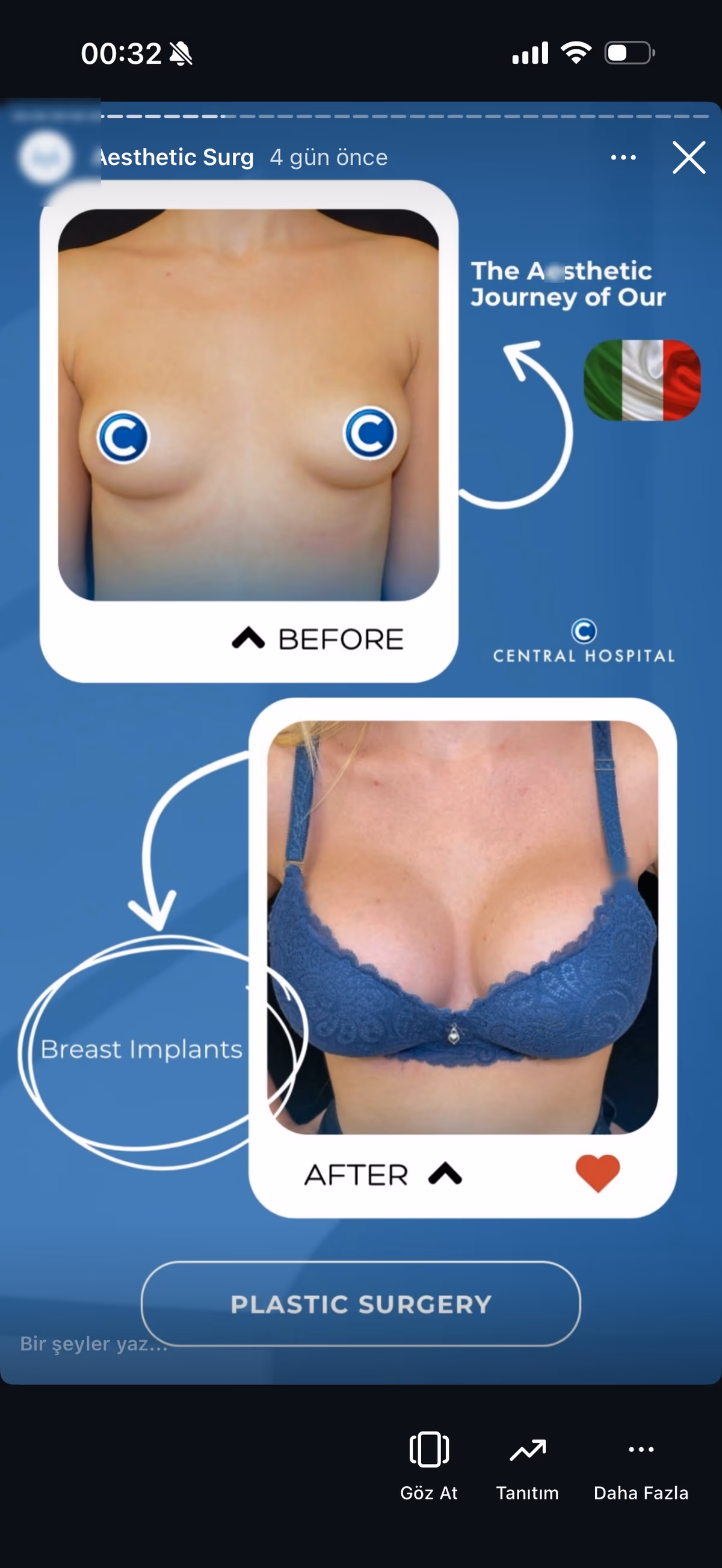 Risultato mastoplastica additiva — paziente SlimFit Turkey 5