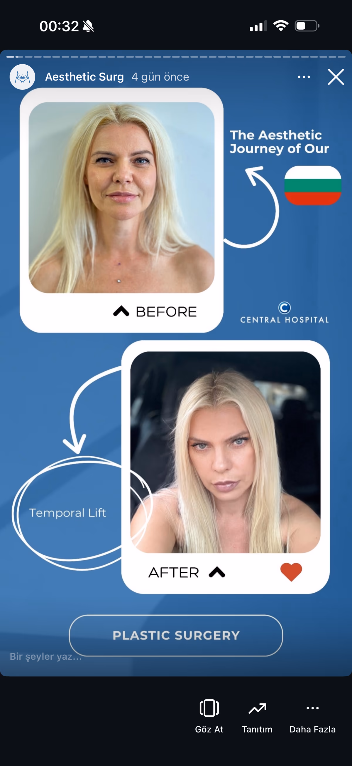Risultato rinoplastica — paziente SlimFit Turkey 1