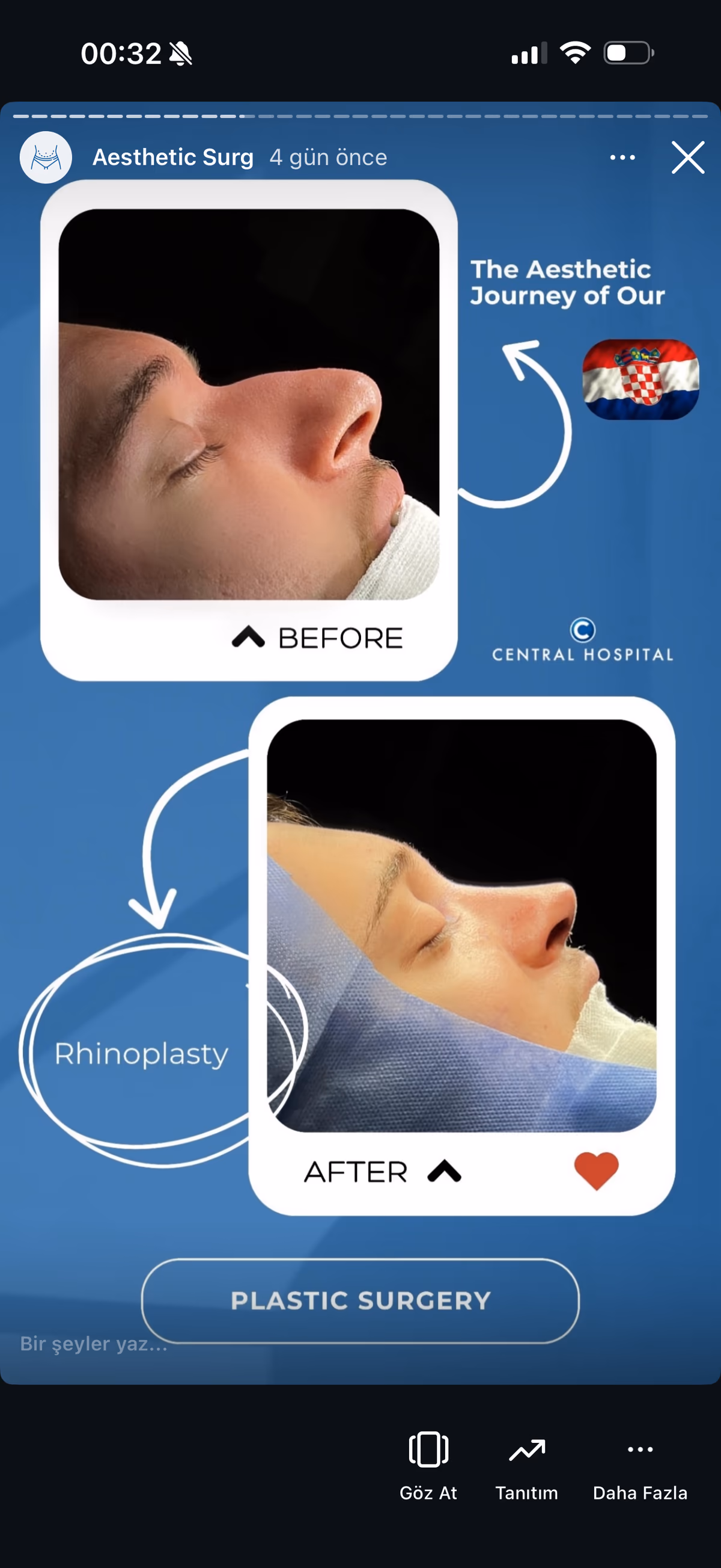 Risultato rinoplastica — paziente SlimFit Turkey 4