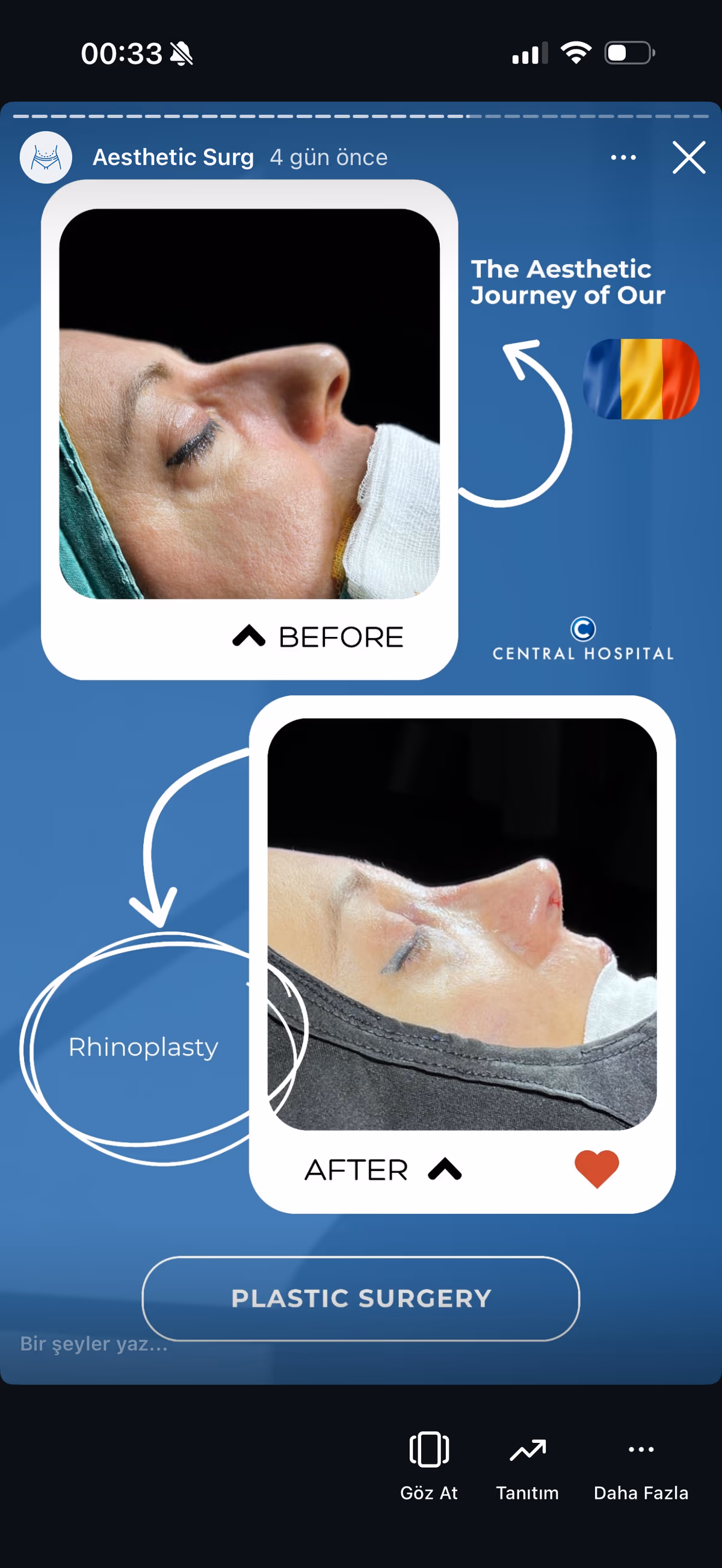 Risultato blefaroplastica — paziente SlimFit Turkey 7