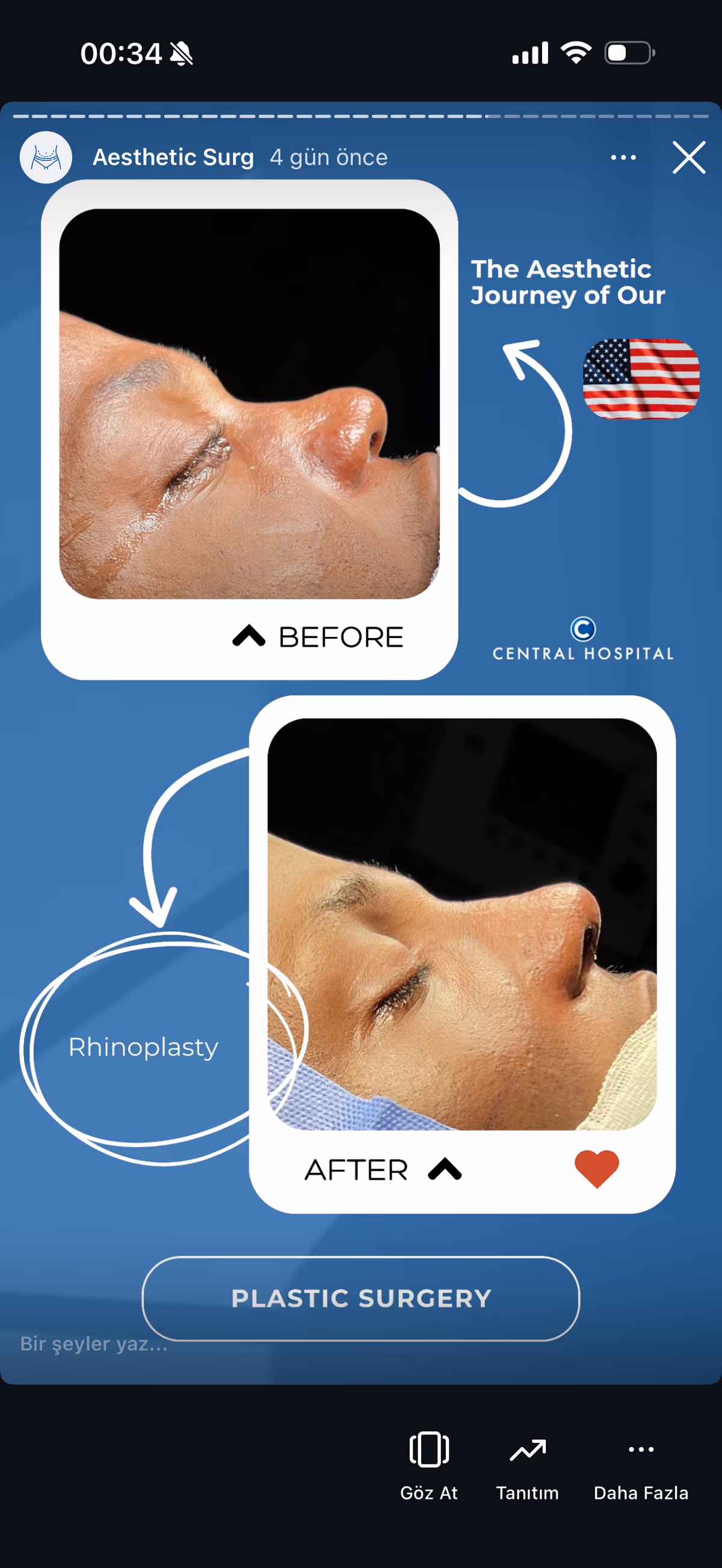 Risultato rinoplastica — paziente SlimFit Turkey 8